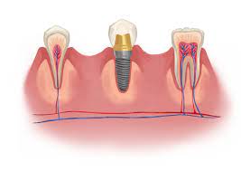 Hierarchical Biomaterial Scaffolds for Periodontal Tissue Engineering: Recent Progress and Current Challenges